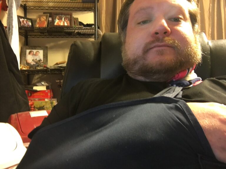 Haha I Broke My Humerus