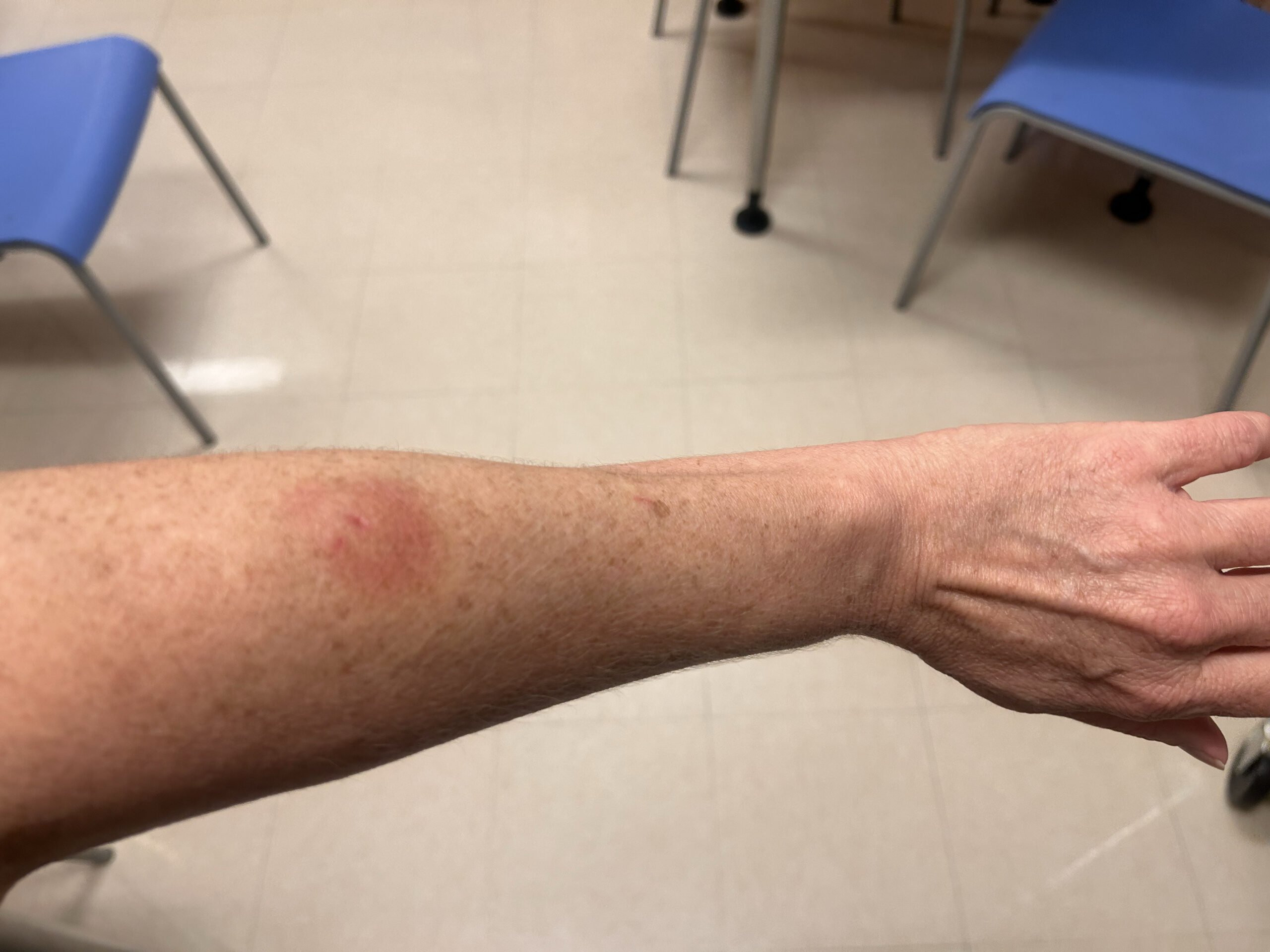 Spider Bite